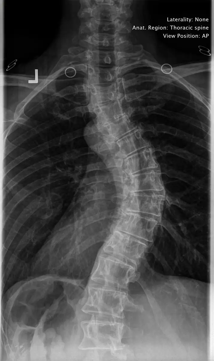 Chiropractor Austin TX Scoliosis X-ray of a patient with Scoliosis .
